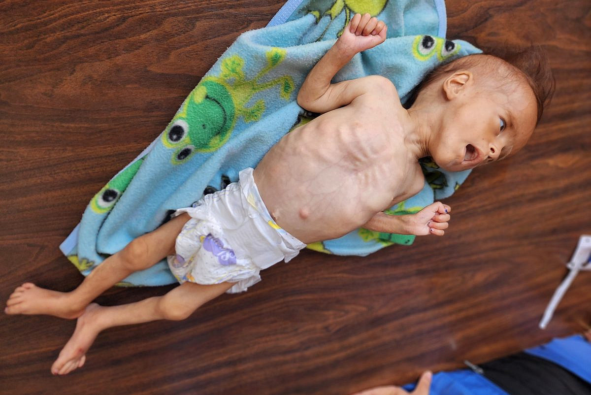Aid for Gaza’s starving children is right at the gates. Let it in.